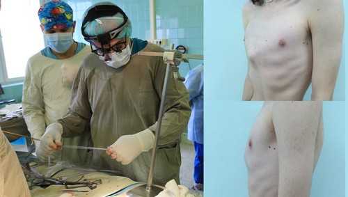 Разновидности деформации грудной клетки